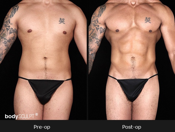 Male Hi Def Liposuction