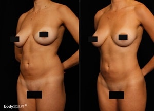 Female Hidef Liposuction