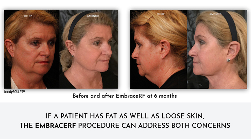 Benefits of Embrace-RF - a Unique One-time Facial Rejuvenation Solution