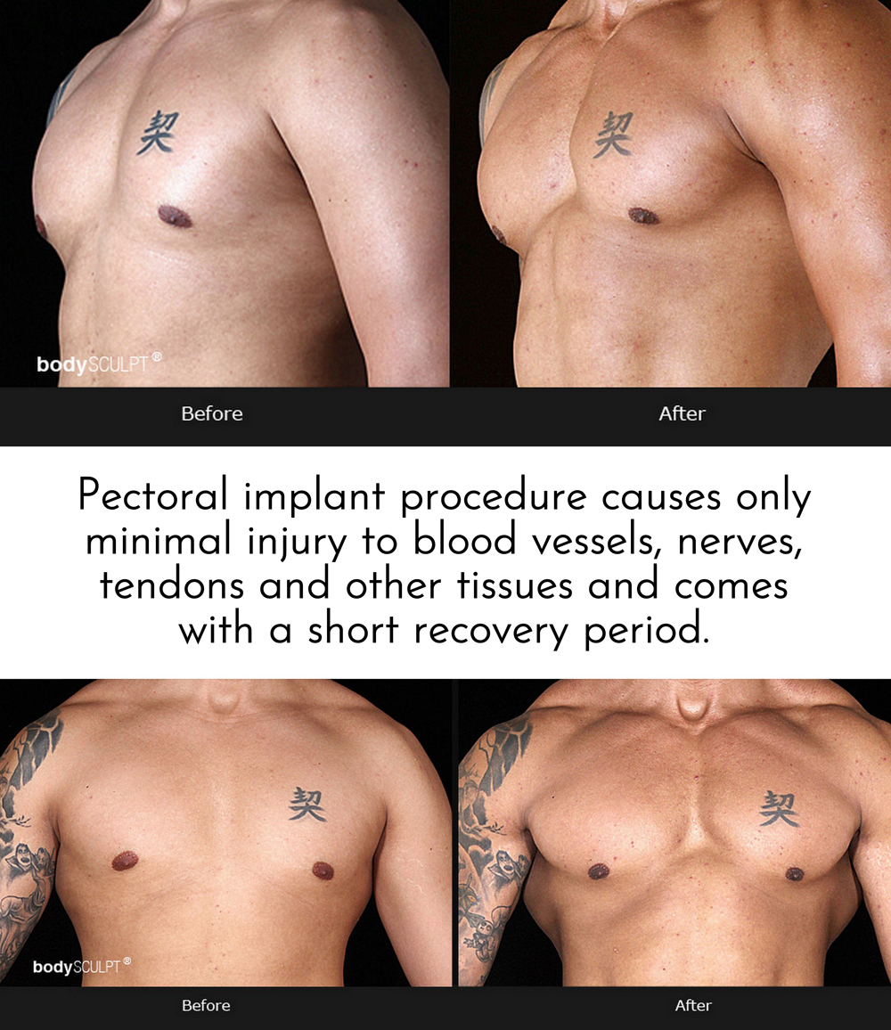 Chest Implants for Men - What You Need to Know
