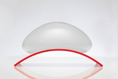How Does the IDEAL Implant Work? IDEAL Implant