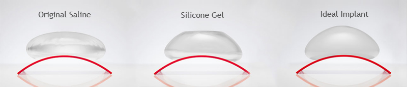 Advantages of the IDEAL Implant over Saline and Silicone Implants