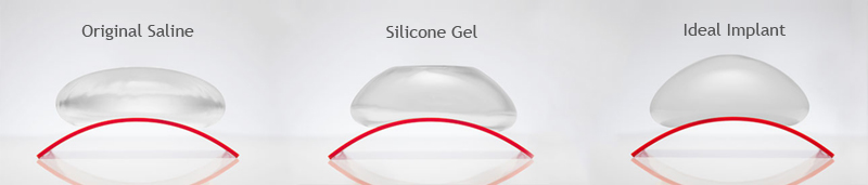 Advantages of the IDEAL Implant over Saline and Silicone Implants