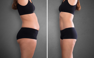 BodyTite Liposuction