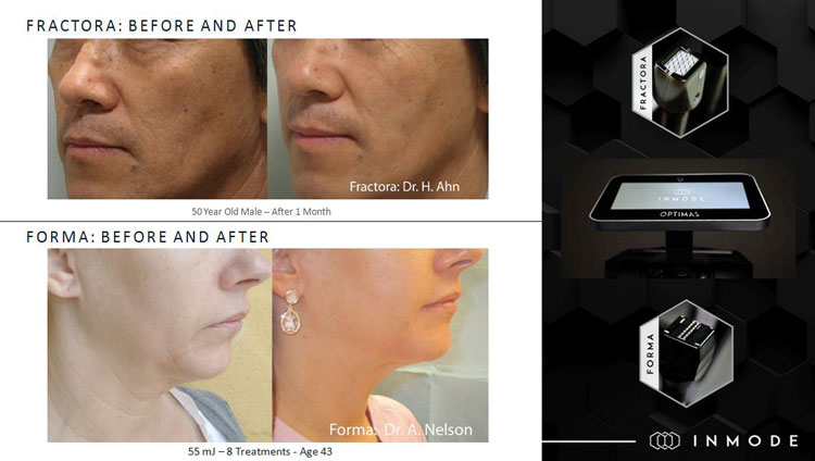 Optimas and Triton - 2 Innovative Technologies for Professional-grade Aesthetic Procedures Aesthetic Procedures