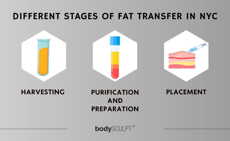 Fat Transfer