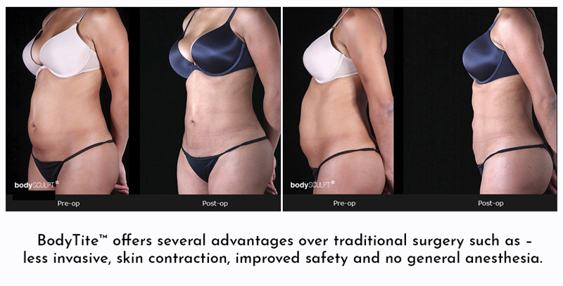 Before and After Photos Bodytite Liposuction Frequently Asked Questions