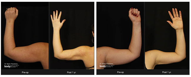 arm lift surgery before after