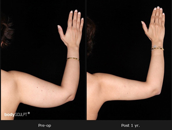 Scarless Arm Lift Surgery - The Latest Advancement in Brachioplasty