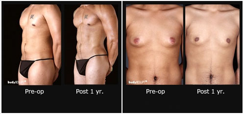 Options To Reduce Male Breast Enlargement