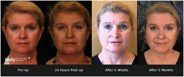 Facelift: What to Expect from the Procedure