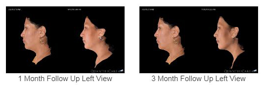 Noninvasive Technology for Facial Remodeling