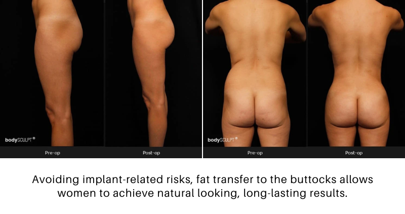 fat transfer