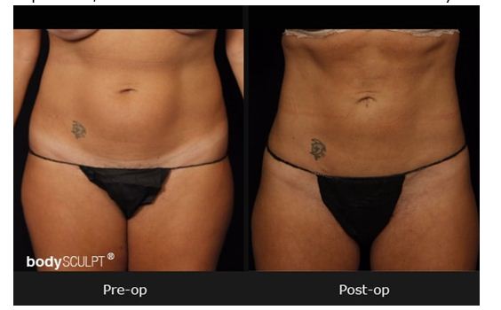 smartlipo triplex