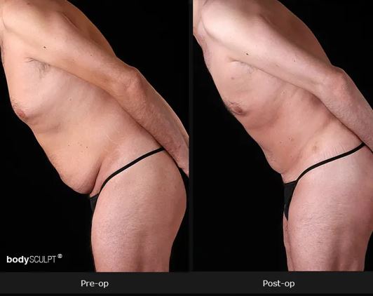 male tummy tuck 