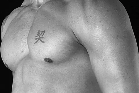 Gynecomastia