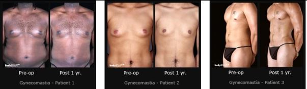 Gynecomastia Surgery Before And After Photos