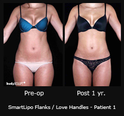 Smartlipo Flanks / Love Handles