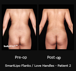 Smartlipo Flanks / Love Handles