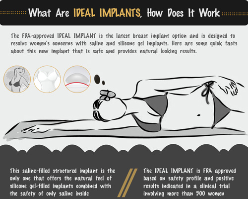 What are IDEAL Implants, How Does it Work