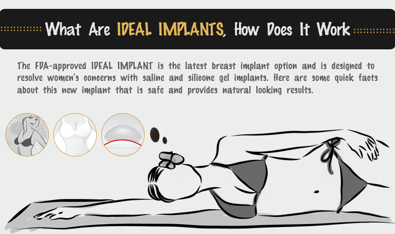 IDEAL Implants