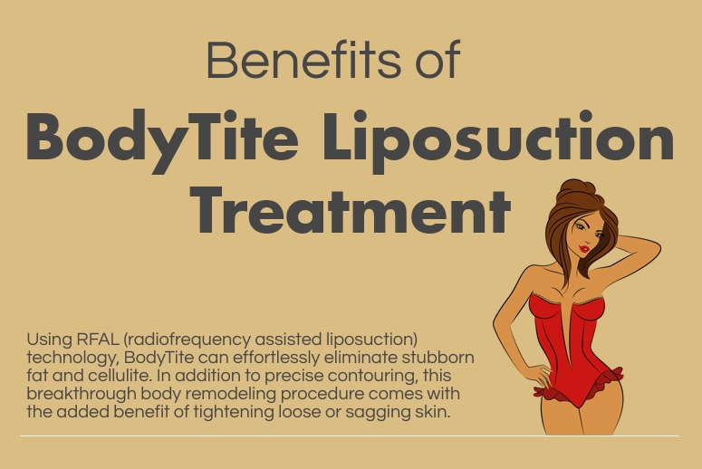 Benefits of BodyTite Liposuction Treatment