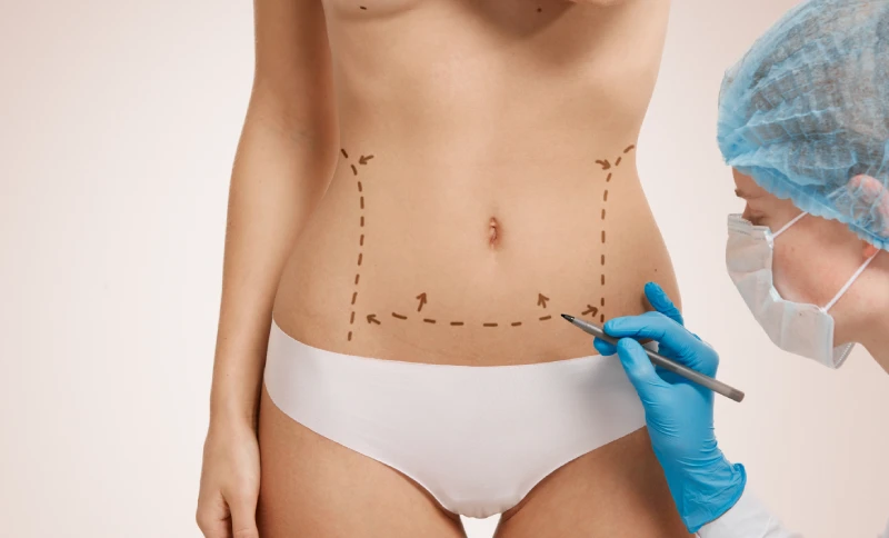 How to Prepare for Body Contouring Surgical Procedure