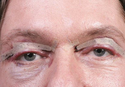 Eyelid Surgery