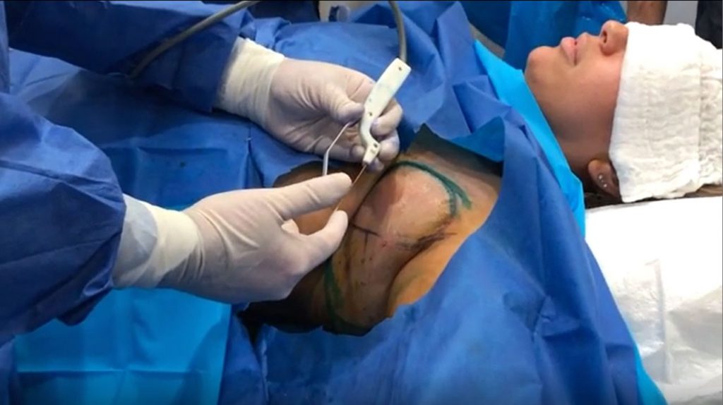 AccuTite Axillary Fat Removal Video