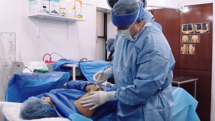 Scarless Arm Lift using BodyTite