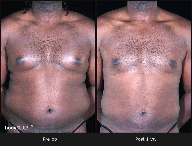 Gynecomastia