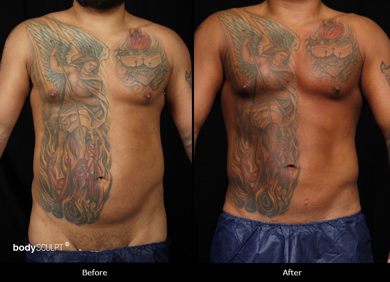 SmartLipo Love Handles (Men) - Before and After Photos