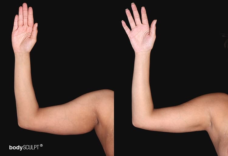 Arm Liposuction Before & After Photos