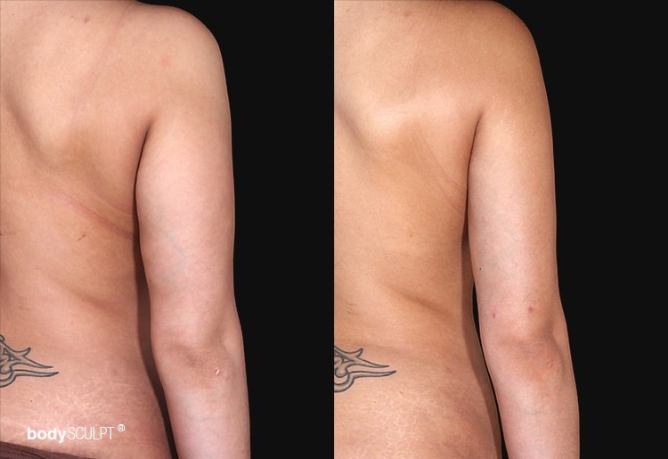 Arm Liposuction Before & After Photos