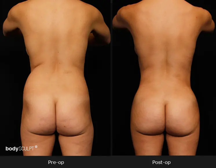 Brazilian Butt Lift - Before and After Photos