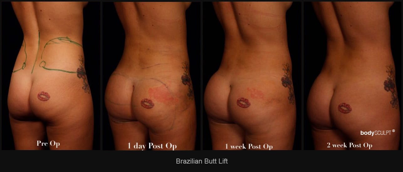 Brazilian Butt Lift - Patient 3