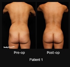 Brazilian Butt Lift - Patient 1