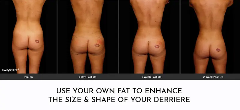 Brazilian Butt Lift vs Butt Implants