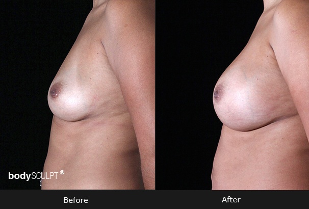 Breast Augmentation - Patient 1
