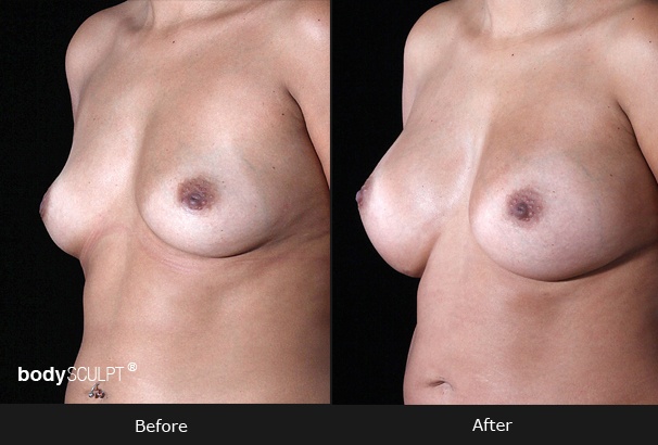 Breast Augmentation - Patient 1