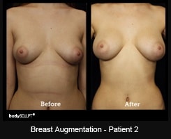 Breast Augmentation - Patient 2