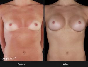 Composite Breast Augmentation - Patient 2