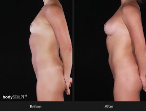 Composite Breast Augmentation - Patient 2