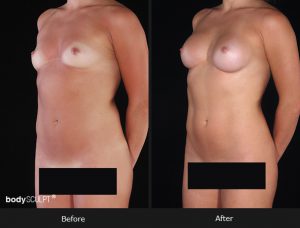 Composite Breast Augmentation - Patient 2