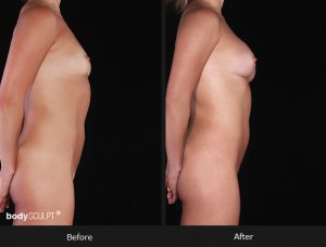 Composite Breast Augmentation - Patient 2