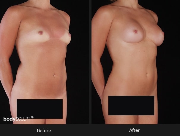 Composite Breast Augmentation - Patient 2