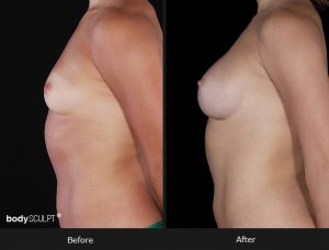 Composite Breast Augmentation - Patient 2