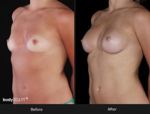 Composite Breast Augmentation - Patient 2