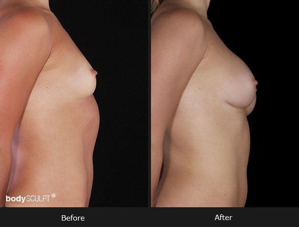 Composite Breast Augmentation - Patient 2