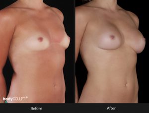 Composite Breast Augmentation - Patient 2